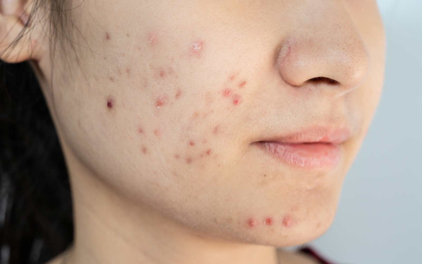 Kvinne med kviser eller akne på haken og nedre del av kinnene.