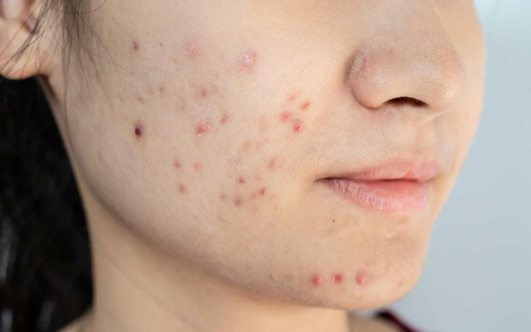 Kvinne med kviser eller akne på haken og nedre del av kinnene.
