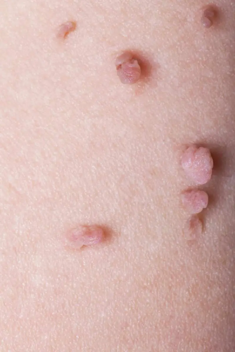 Skin tags