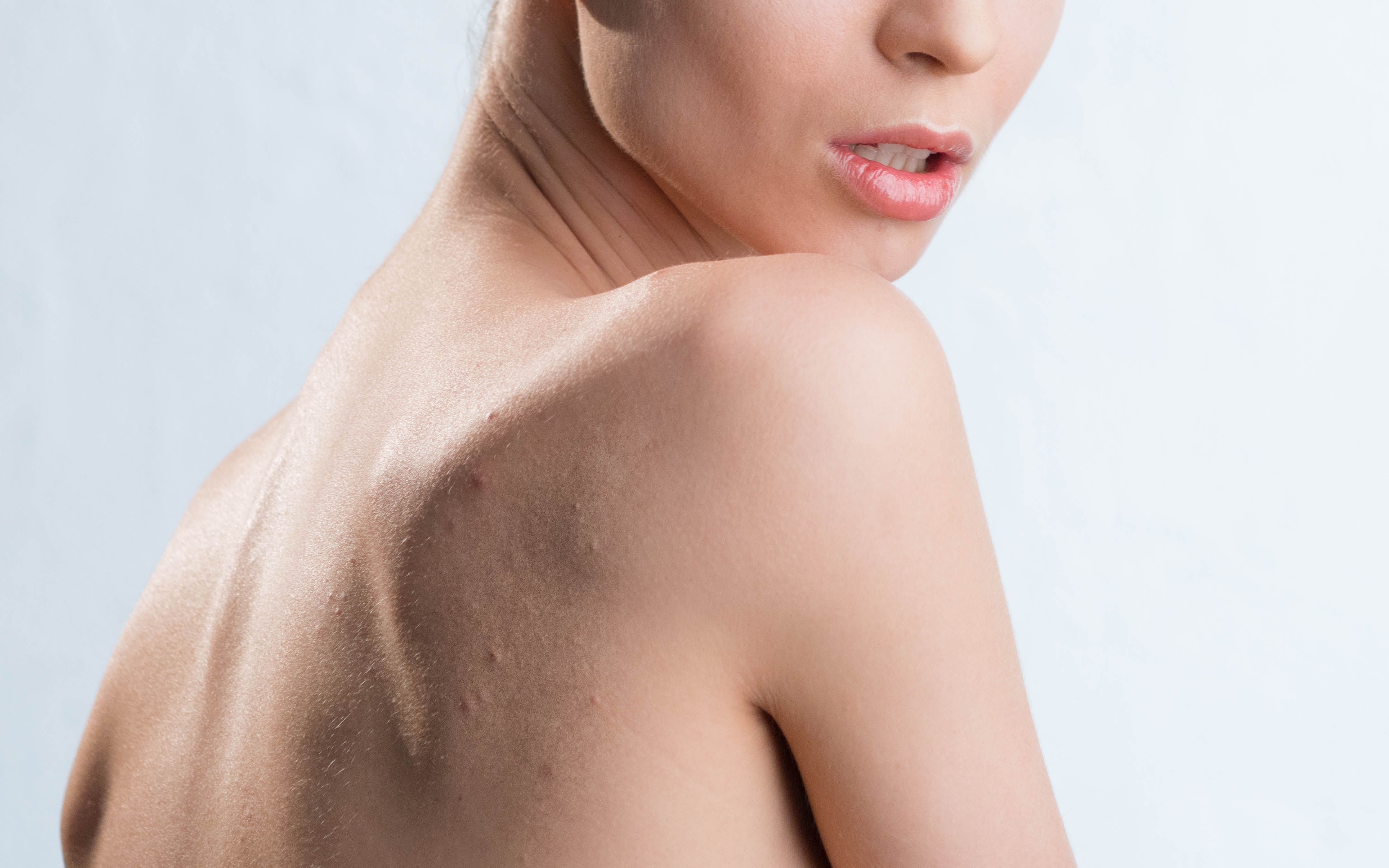 Bilde viser ryggen og skulder til en kvinne med kviser på ryggen. 