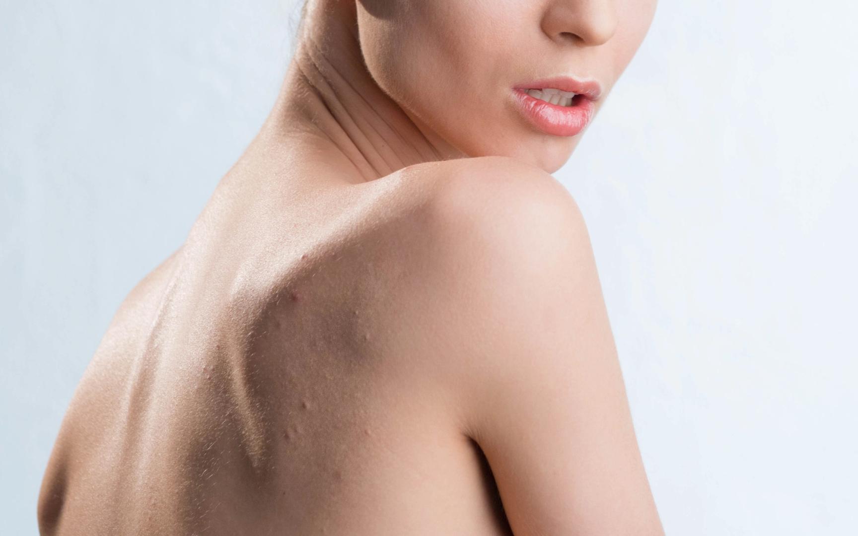 Bilde viser ryggen og skulder til en kvinne med kviser på ryggen.