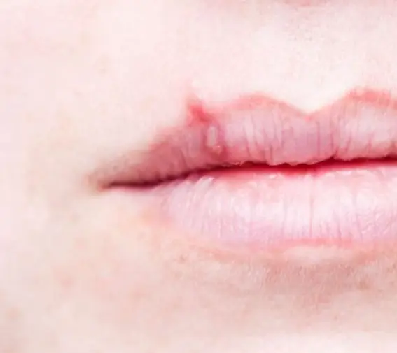Herpes munnsår på overleppen