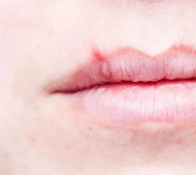 Herpes munnsår på overleppen