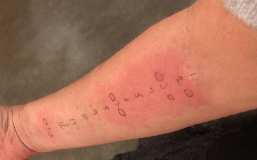 En arm hvor det er gjort en rekke tester. Ser at noen har gitt utslag ved at det har hovnet opp