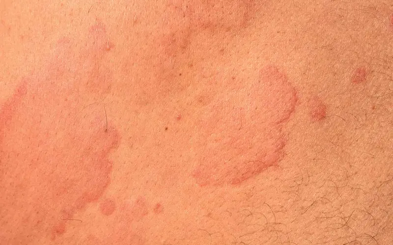 Utslett ved elveblest