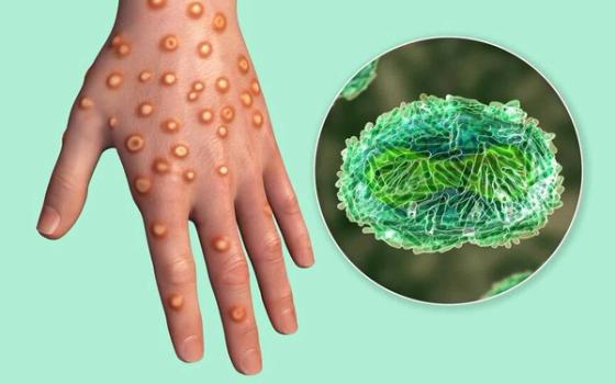 Apekopper (mpox) Apekopper (mpox)