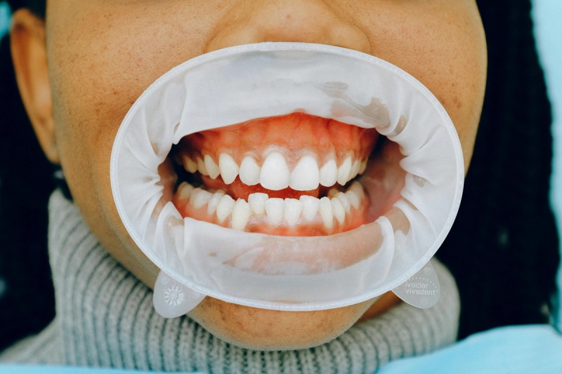 Gum Treatment