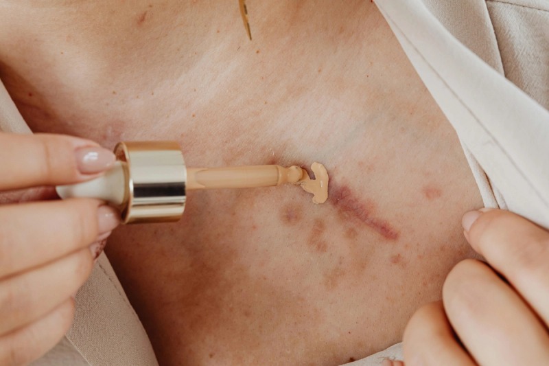 Scar and Pigmentation Treatment