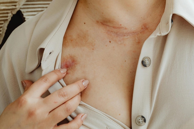 Eczema and Psoriasis Management