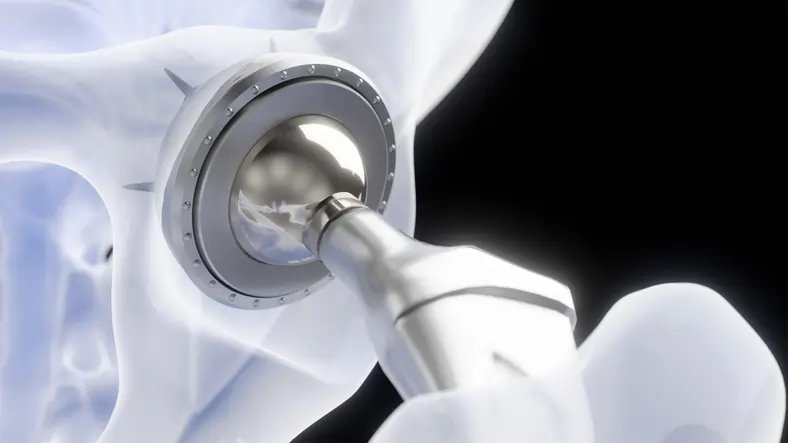 Hip Replacements: Market Set to Reach $13.7B by 2034 with Tech-Driven Advancements - Research Reports news and analysis from Global Banking & Finance Review