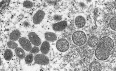Image for India confirms Asia’s first monkeypox death