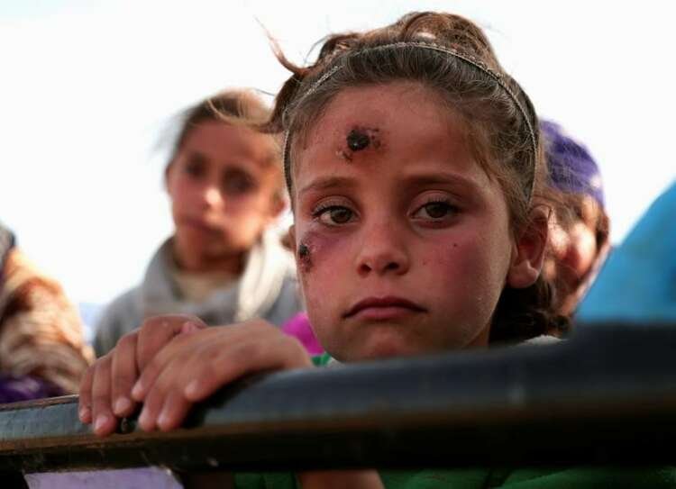 A girl, who according to her parents is showing symptoms of Leishmaniasis, returns with others to their town of Hisha, after the Syrian Democratic Forces (SDF) took control of the area from Islamic State militants, in the northern Raqqa countryside