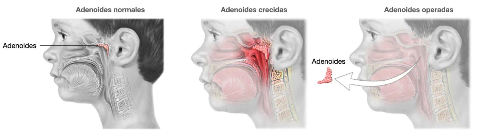Adenoides, Adenoiditis, Adenoidectomía, Cirugía Láser de Adenoides en Niños y Adultos