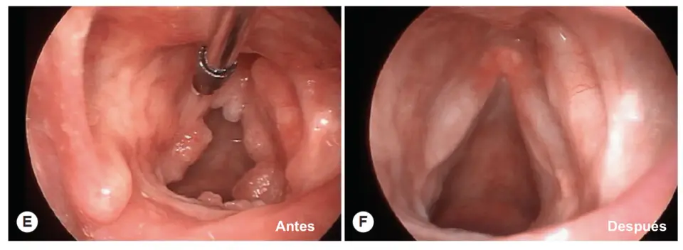 Papiloma Laríngeo (VPH) / PRR: Tratamiento Avanzado Adultos y Niños | Vocalia Otorrinolaringólogos ® Guadalajara
