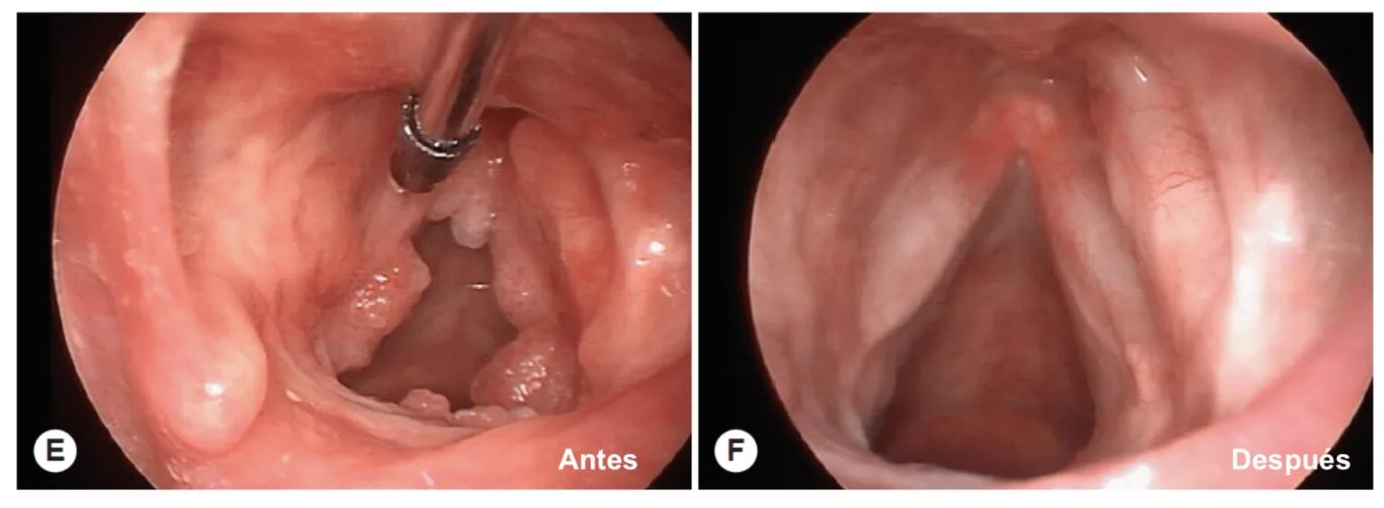 Papiloma Laríngeo (VPH), Papilomatosis Respiratoria Recurrente (PRR) / : Diagnóstico y Tratamiento Avanzado