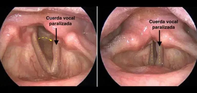 Parálisis de Cuerdas Vocales: Diagnóstico y Tratamiento Especializado en Guadalajara
