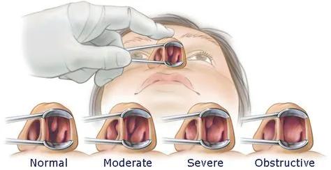 NARIZ, cornetes, tabique, Otorrinolaringólogo especializado, Tratamiento de cornetes, Cirugía de tabique desviado, Soluciones para dificultad respiratoria, Problemas de nariz, Respiración nasal mejorada, Tratamiento de rinitis, Desviación del tabique nasal, Cirugía nasal reconstructiva, Tratamiento de sinusitis Mejora de la respiración nasal, Cirugía de cornetes nasales, Soluciones para apnea del sueño, Tratamiento de congestión nasal, Corrección de tabique nasal, Clínica de otorrinolaringología, Especialista en problemas respiratorios, Salud nasal, Cuidado de la nariz y senos paranasales, Tratamiento de pólipos nasales, Dr. Gerardo López Guerra, Vocalia ® Otorrinolaringólogo Guadalajara