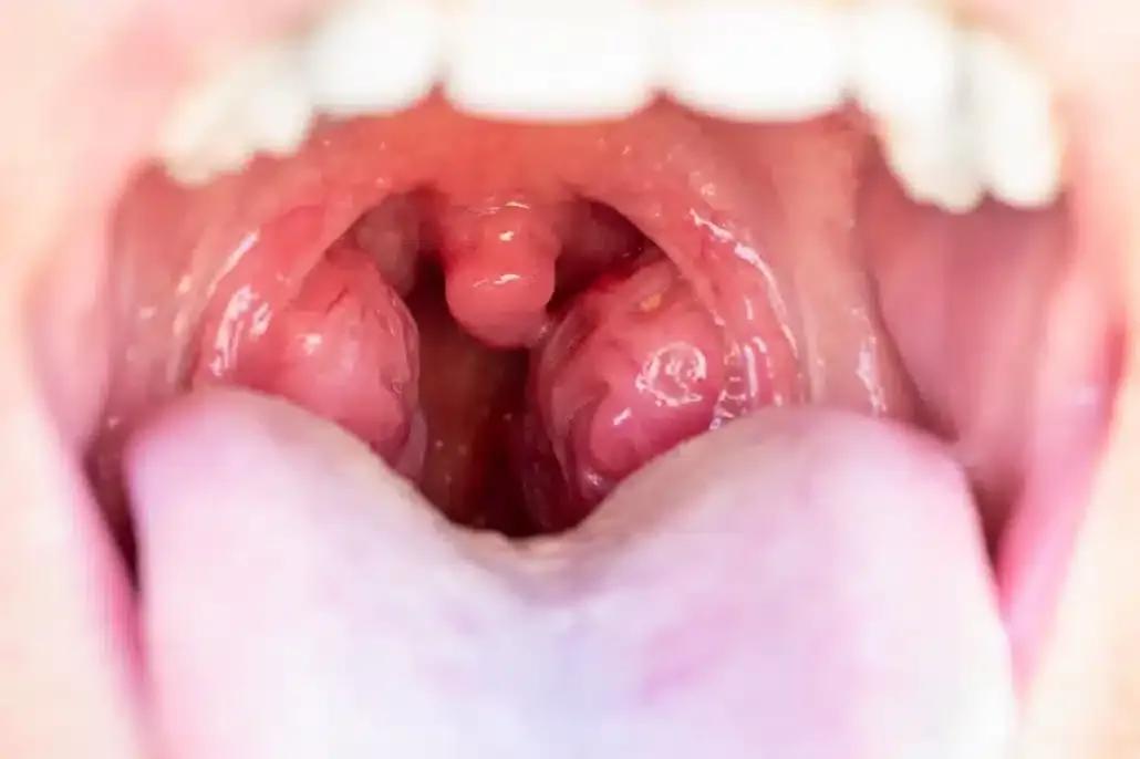 Amigdalitis en Niños: Síntomas, Tratamiento y Prevención, Vocalia Otorrinolaringólogos - Dr. Gerardo Lopez Guerra, Otorrino Guadalajara