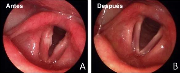 Laringitis: Causas, Síntomas y Tratamientos