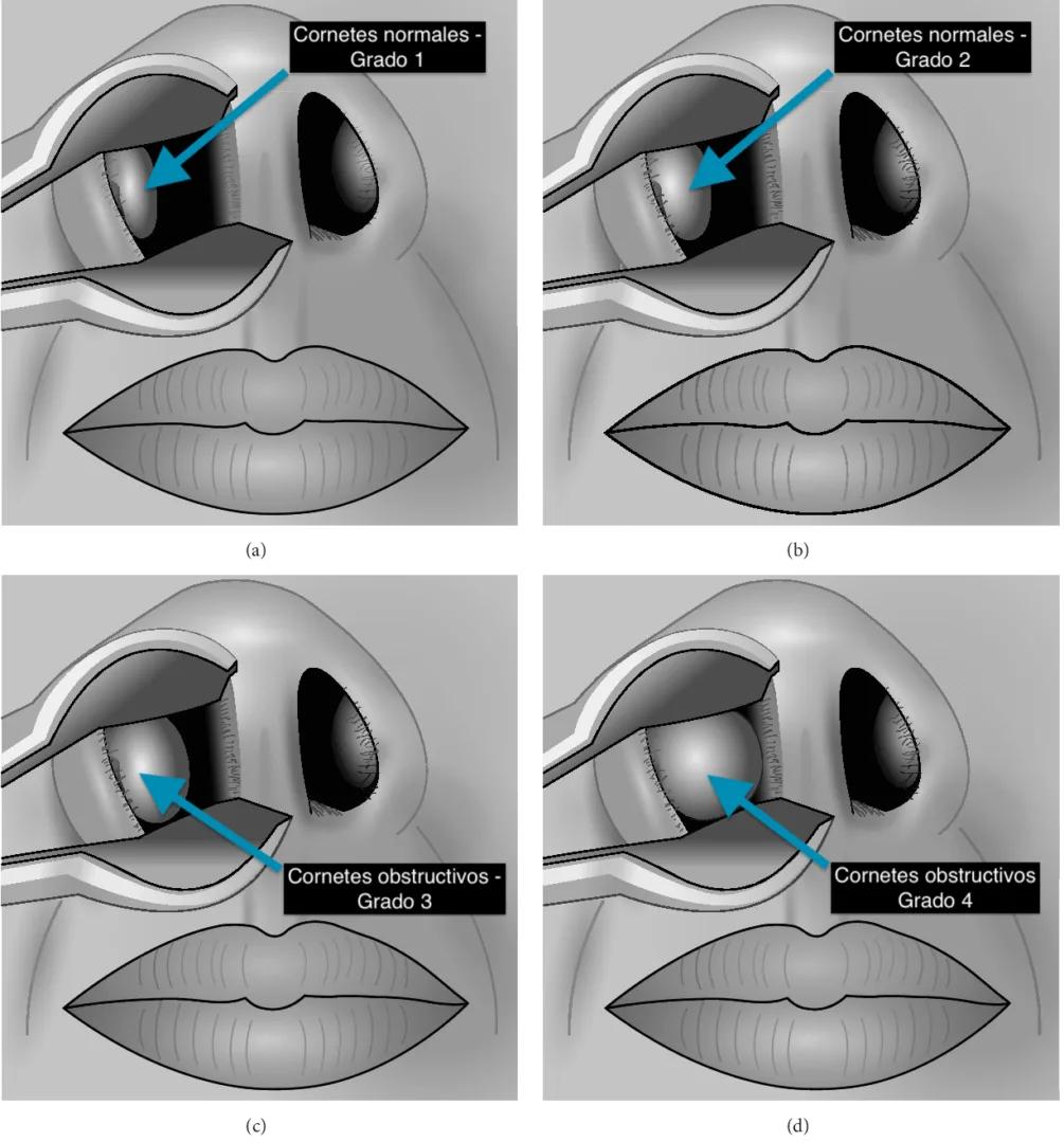 CORNETES, CIRUGÍA DE CORNETES, LÁSER, OBSTRUCCIÓN NASAL, RINITIS CRÓNICA - Otorrinolaringólogo en Guadalajara - Oídos, Nariz, Garganta y Voz, - Dr. Gerardo López Guerra, ORL y CCC, FACS.