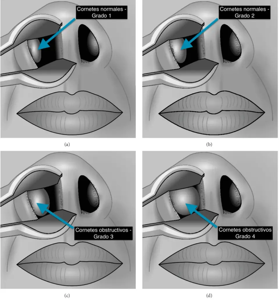 CORNETES, CIRUGÍA DE CORNETES, LÁSER, OBSTRUCCIÓN NASAL, RINITIS CRÓNICA - Otorrinolaringólogo en Guadalajara - Oídos, Nariz, Garganta y Voz, - Dr. Gerardo López Guerra, ORL y CCC, FACS.