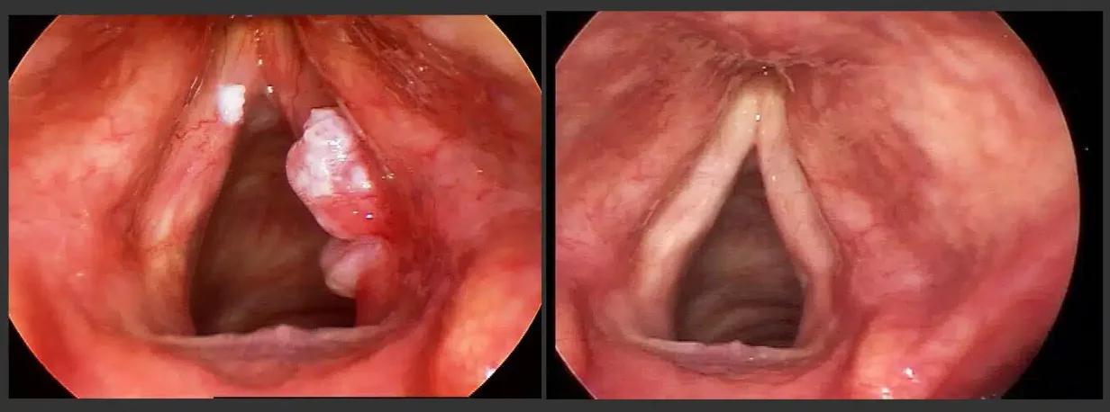 Cáncer de Laringe: Causas, Síntomas y Tratamientos Avanzados