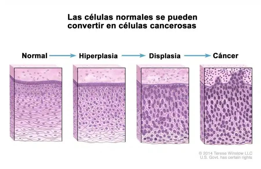 Tratamiento del cáncer de laringe - Dr. Gerardo López Guerra