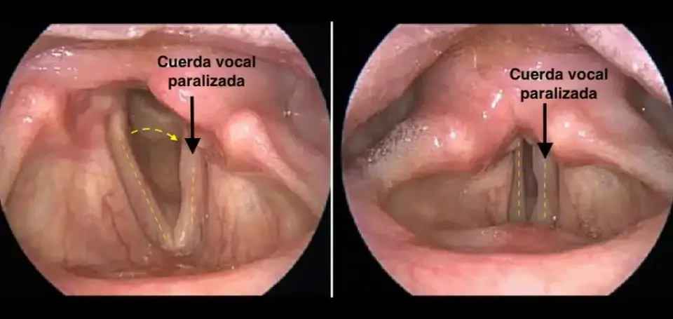 Parálisis Cuerdas Vocales: Tratamiento Avanzado (Laringoplastia, Láser) | Vocalia ® Guadalajara