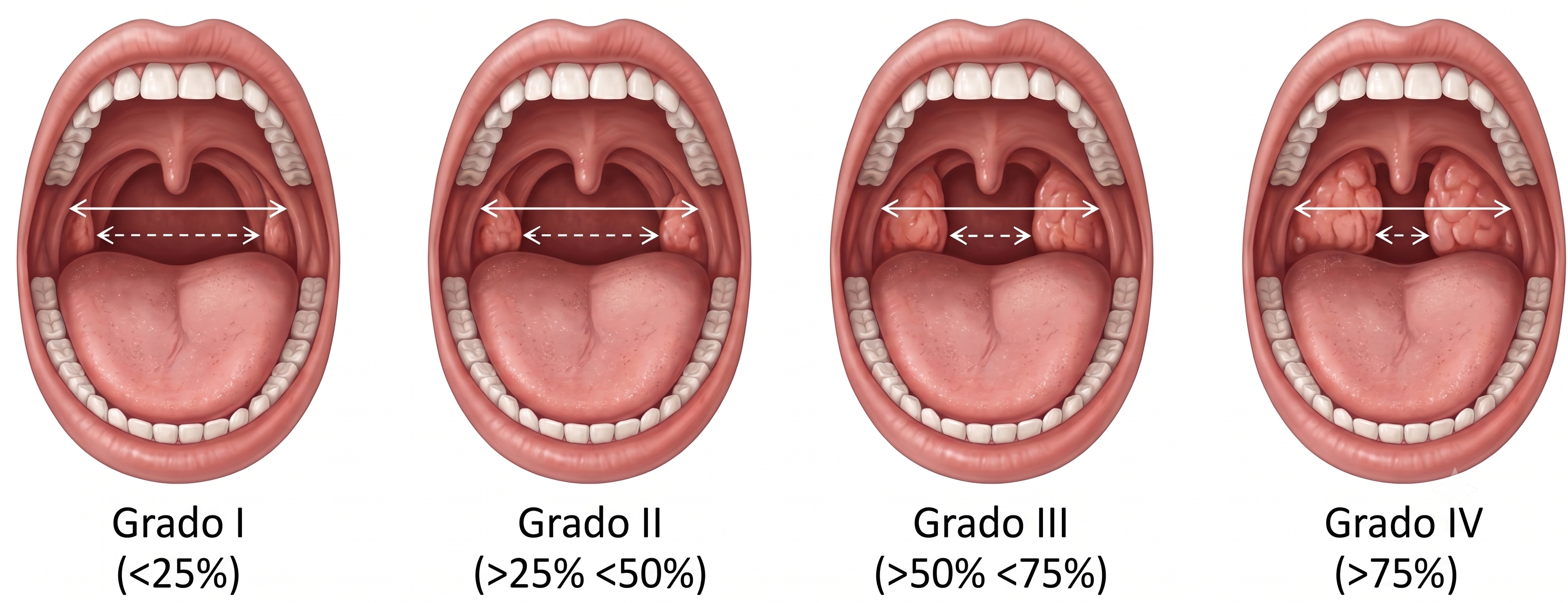 AMÍGDALAS, AMIGDALITIS NIÑOS, AMIGDALECTOMÍA LÁSER -Otorrinolaringólogo en Guadalajara - Oídos, Nariz, Garganta y Voz, - Dr. Gerardo López Guerra, ORL y CCC, FACS.