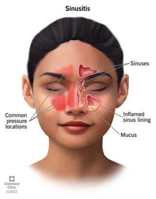 Sinusitis, tratamiento, Otorrinolaringólogo Guadalajara
