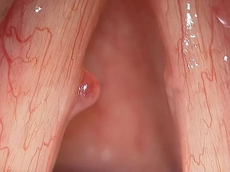 Pólipos de Cuerdas Vocales: Diagnóstico y Tratamiento Avanzado en Guadalajara