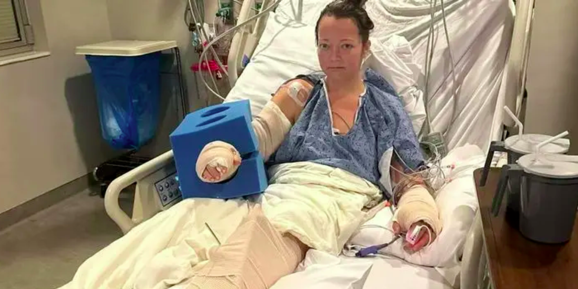 Tennessee mom loses leg after pit bull mauls her during dog fight in her home