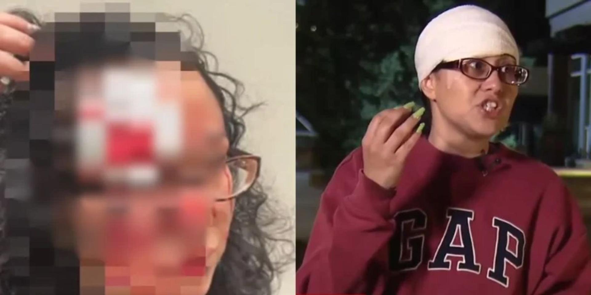 Seattle homeless woman arrested for biting chunk from stranger’s face while yelling racial slurs in random attack