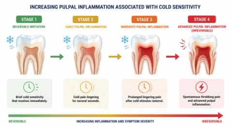 Timeline showing progression from brief cold sensitivity to prolonged lingering pain as inflammation inside the tooth advances.