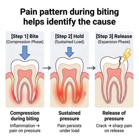 Sequence showing pain during biting pressure caused by inflammatory loading and sharp release pain caused by movement within a cracked tooth.