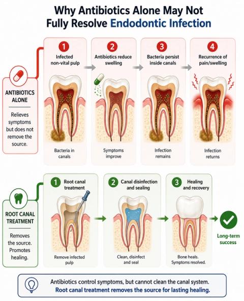 Clinical progression model demonstrating temporary symptom suppression with antibiotics alone versus definitive infection elimination through root canal treatment, highlighting recurrence risk when endodontic source control is not achieved.