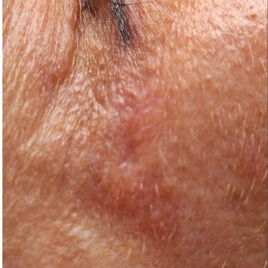 Blizna po blepharoplastyce — powieki górne i dolne — przed