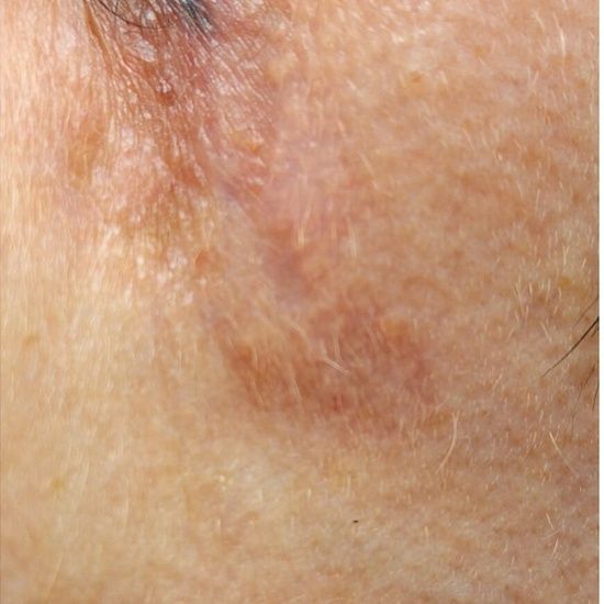 Blizna po blepharoplastyce — powieki górne i dolne — po