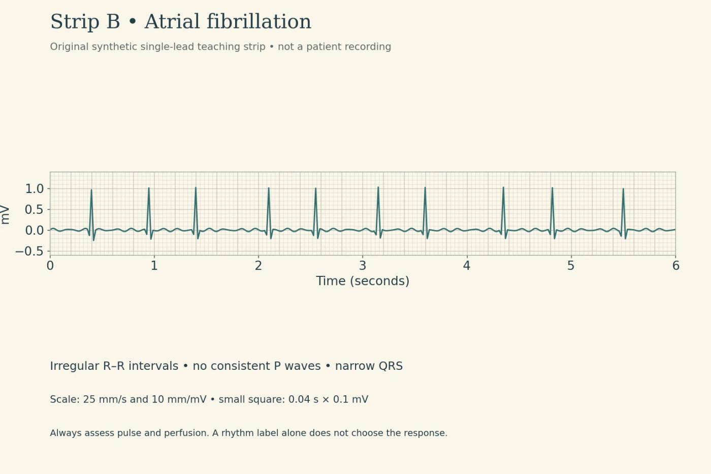 Original six-second atrial fibrillation teaching strip with irregular R–R intervals and no consistent discrete P waves.