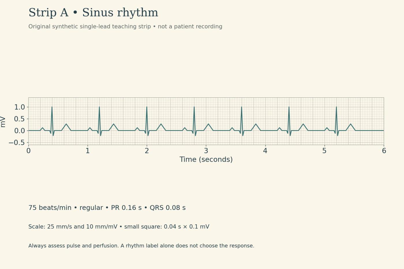 Original six-second sinus rhythm teaching strip at 75 beats per minute, PR 0.16 second and QRS 0.08 second.