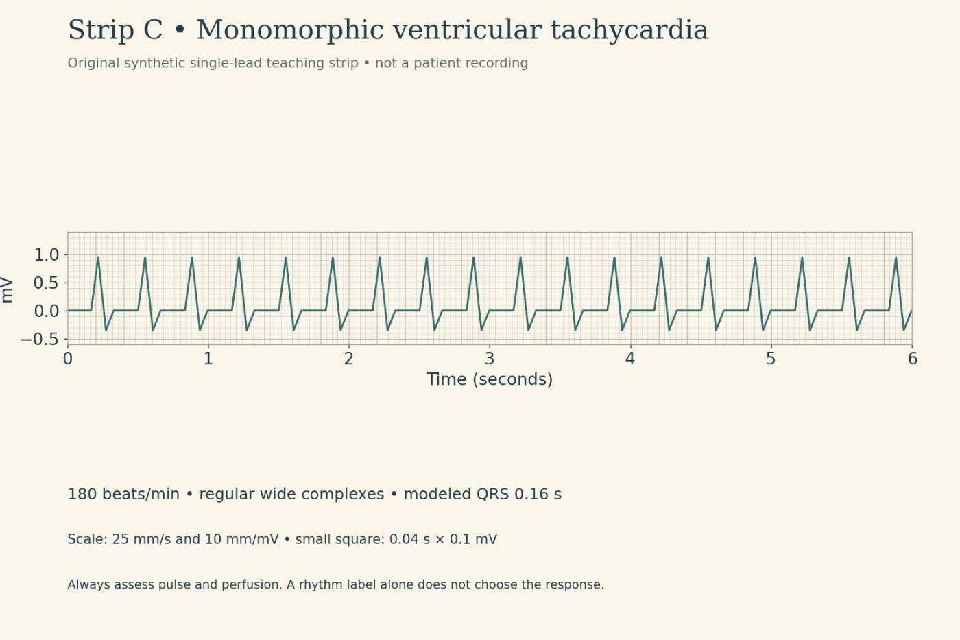 Original monomorphic ventricular tachycardia teaching strip at 180 beats per minute with 0.16-second QRS complexes.
