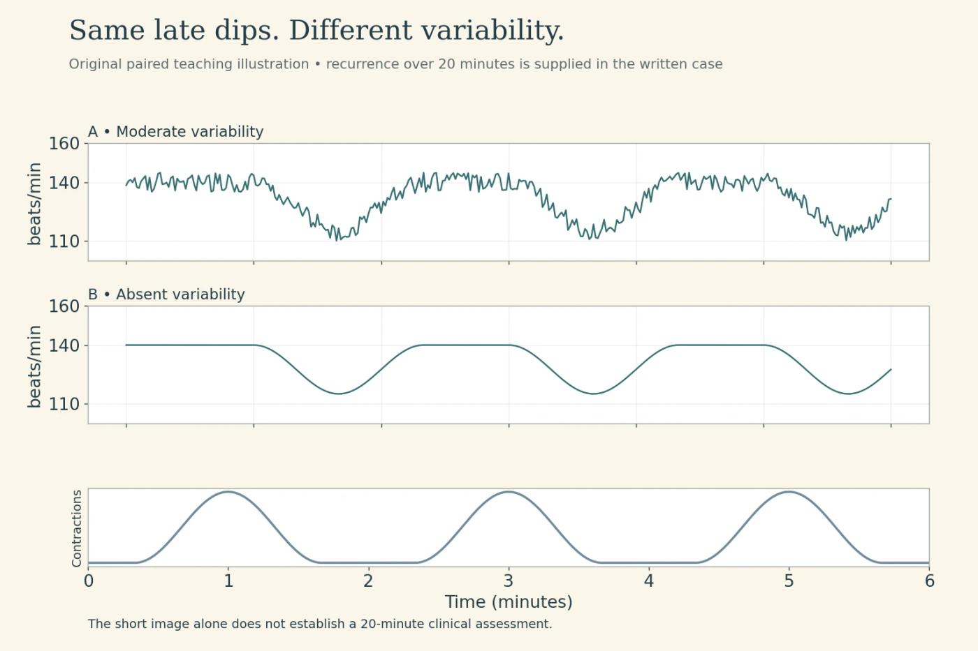 Paired late-deceleration teaching traces compare moderate variability with absent variability above the same contractions.