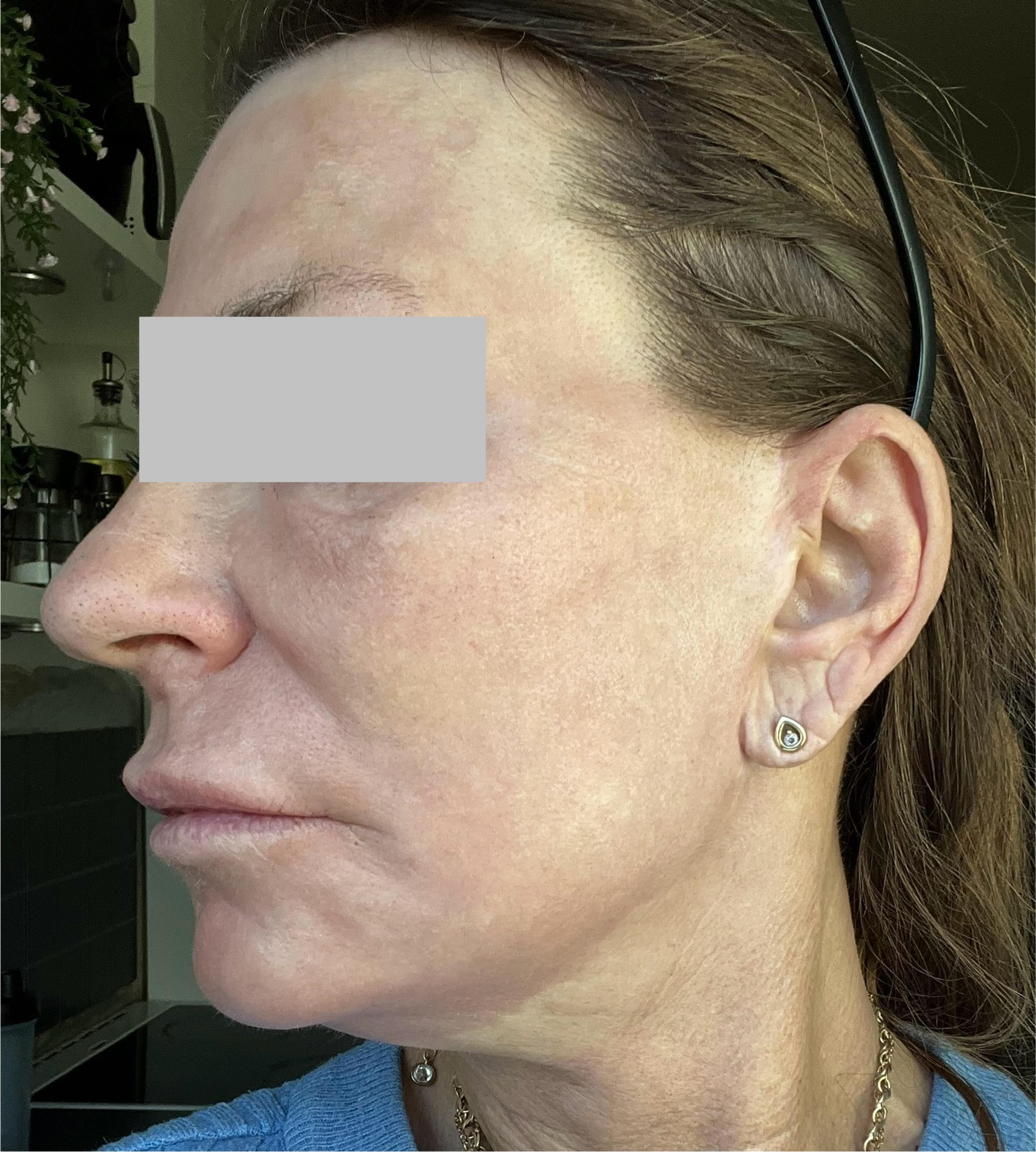 A client after having Kemisk ansigtspeeling 