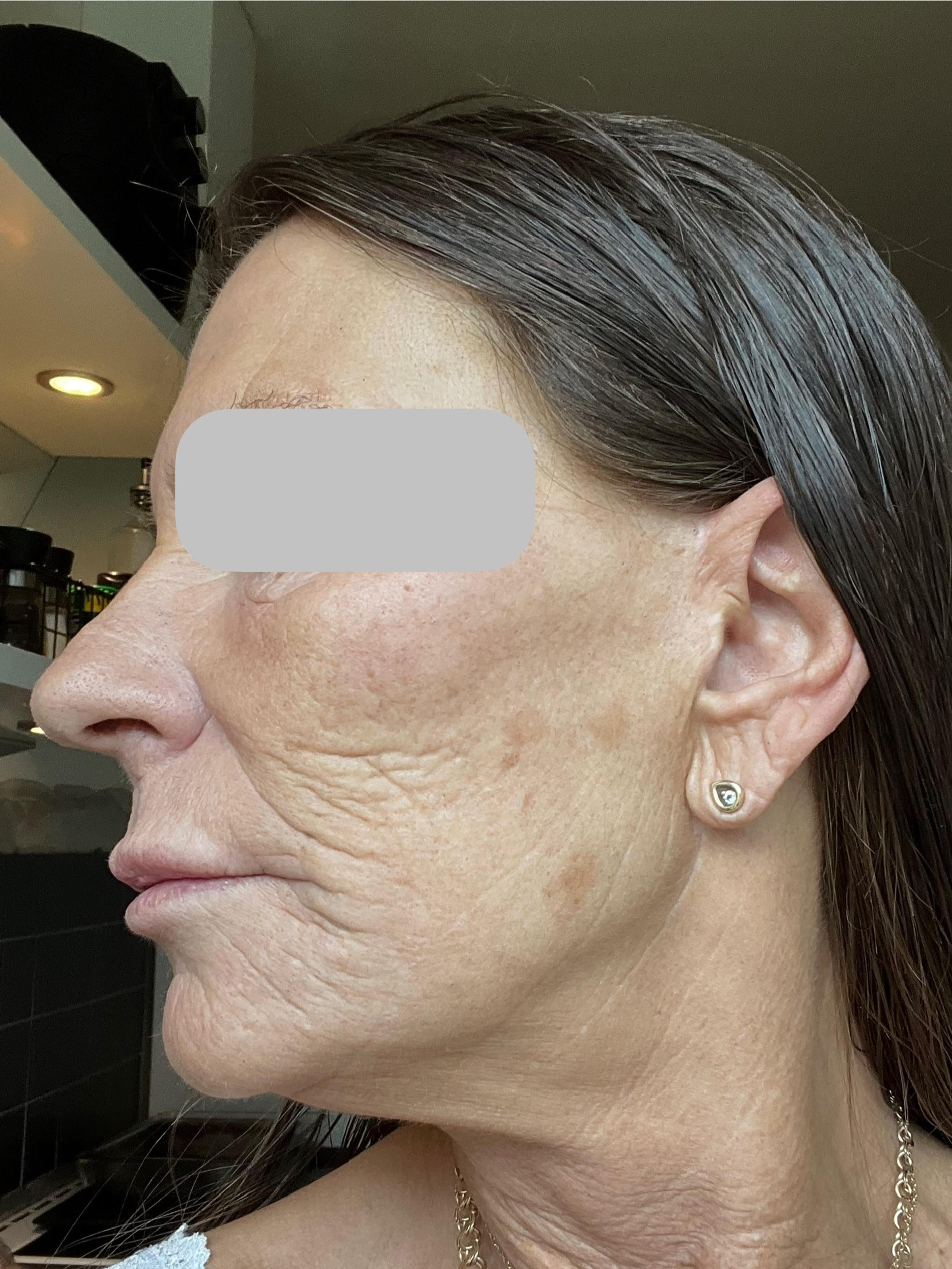 A client before having Kemisk ansigtspeeling 