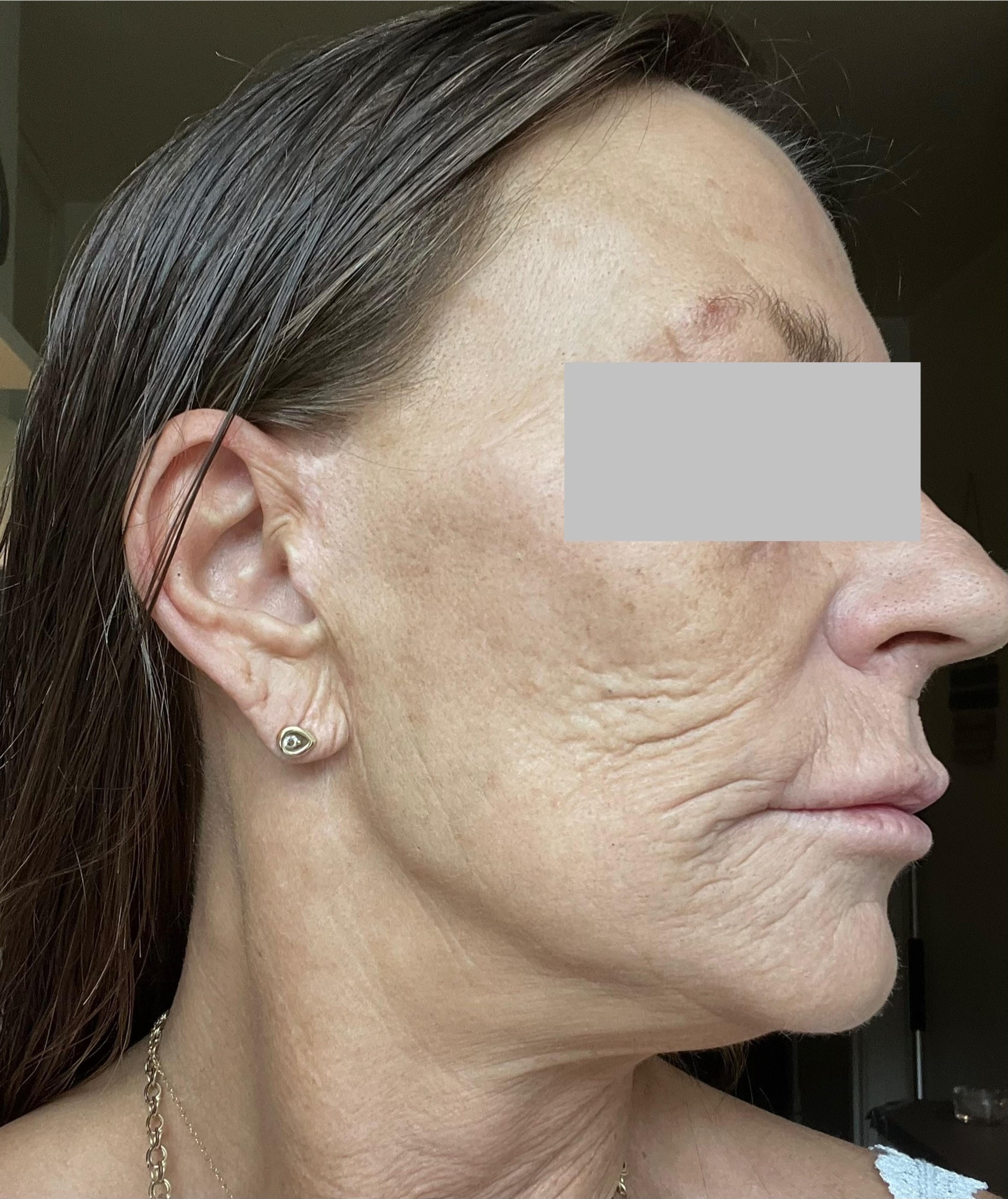 A client before having Kemisk ansigtspeeling 