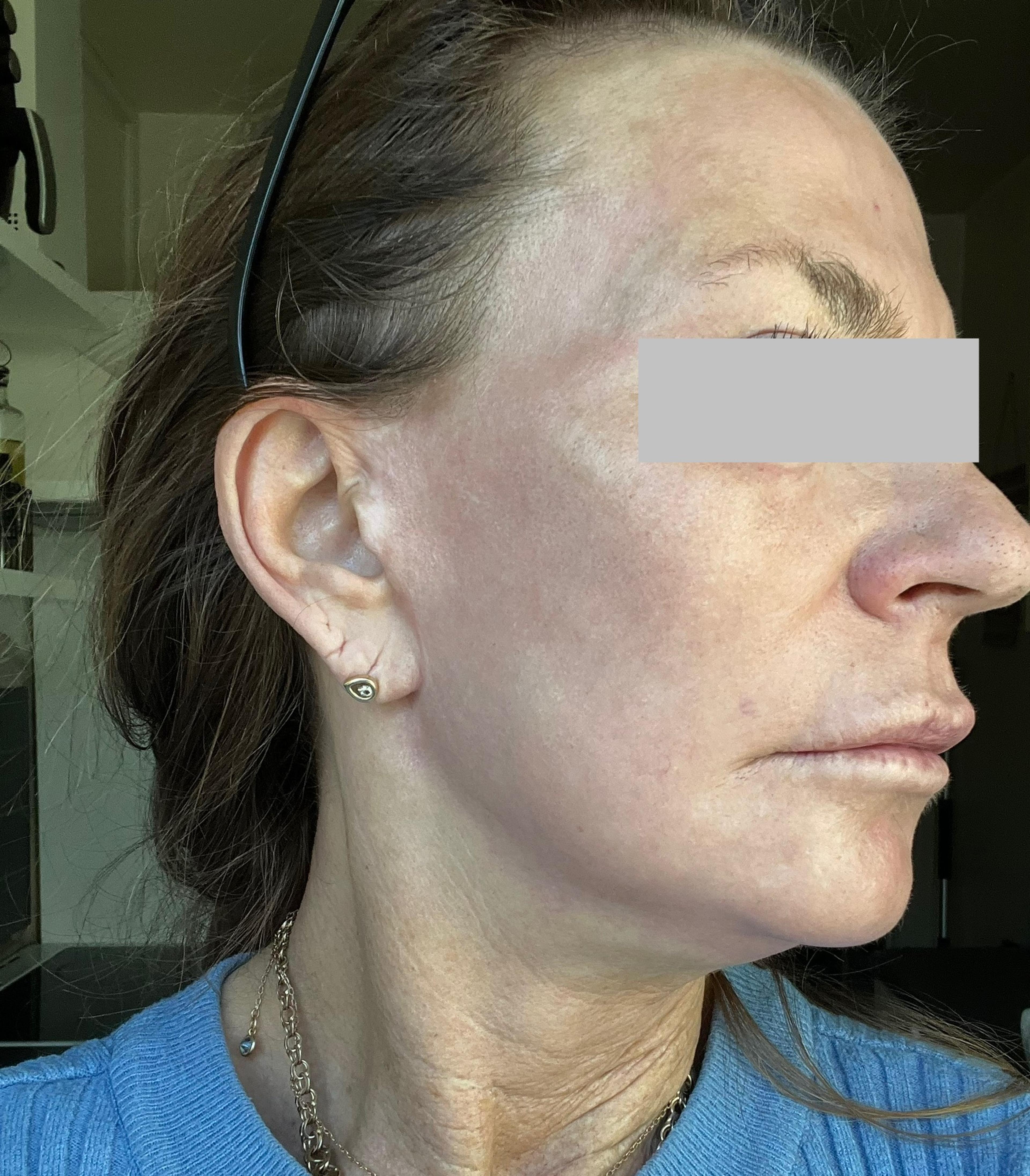 A client after having Kemisk ansigtspeeling 