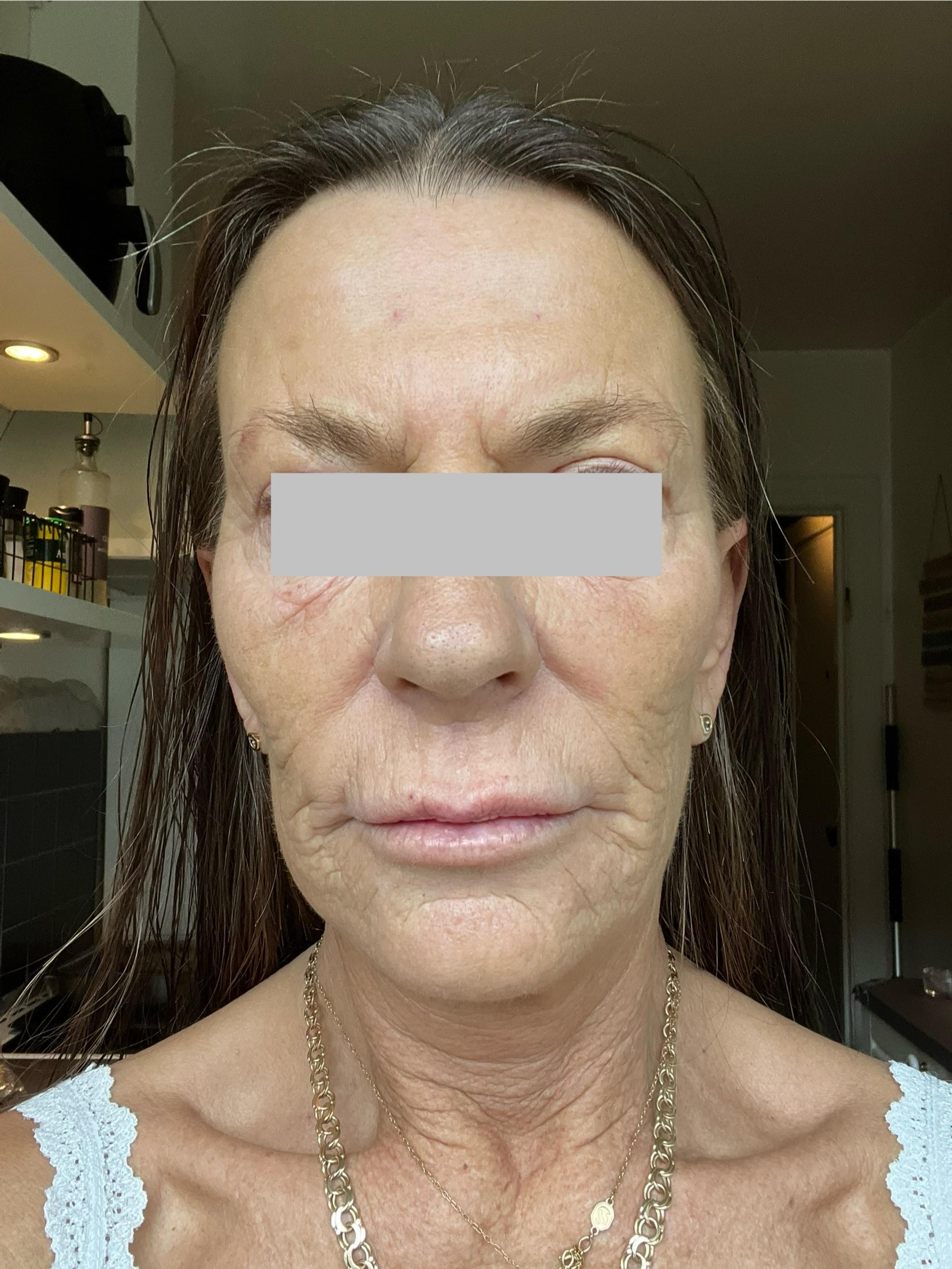 A client before having Kemisk ansigtspeeling 