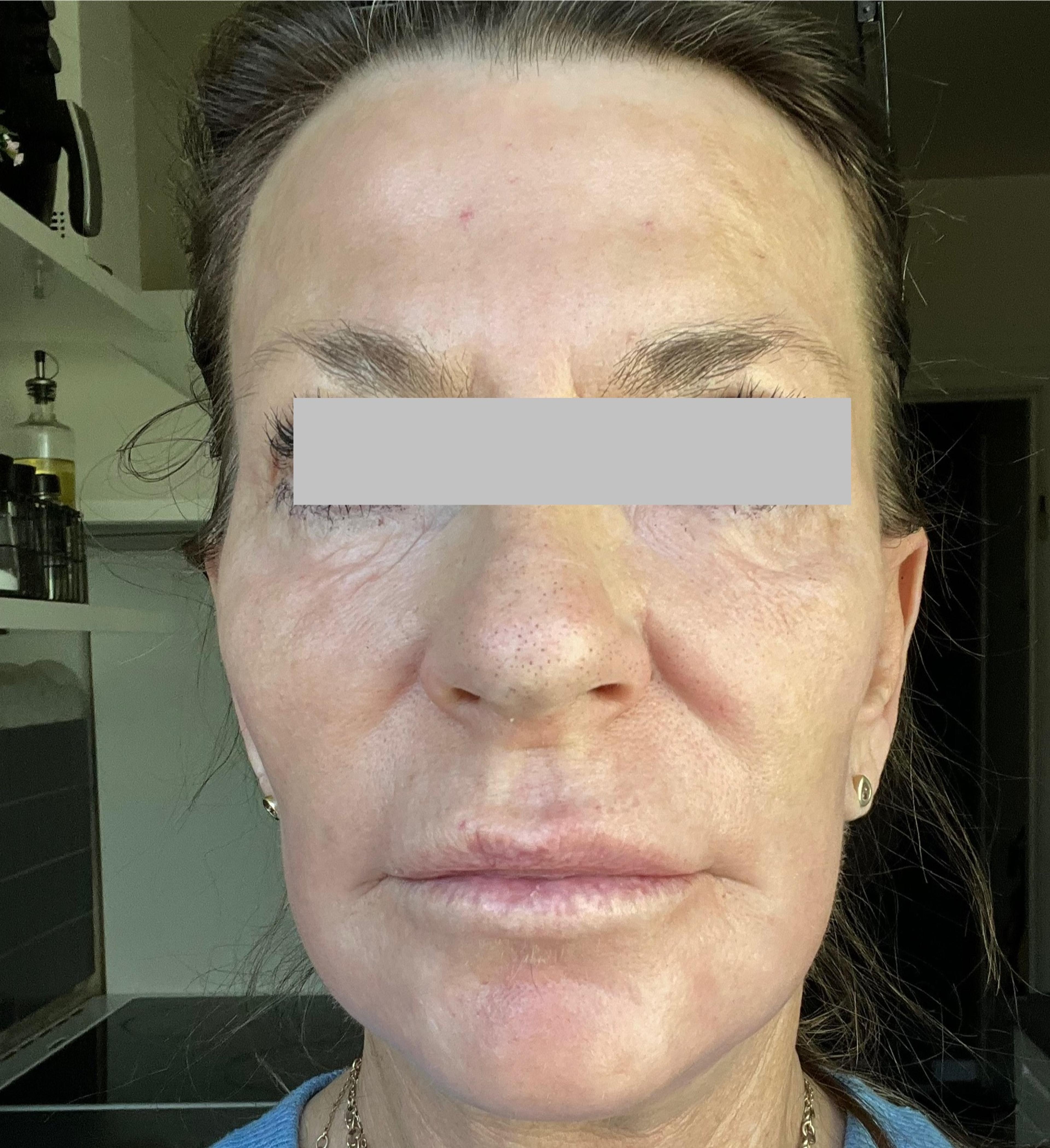 A client after having Kemisk ansigtspeeling 