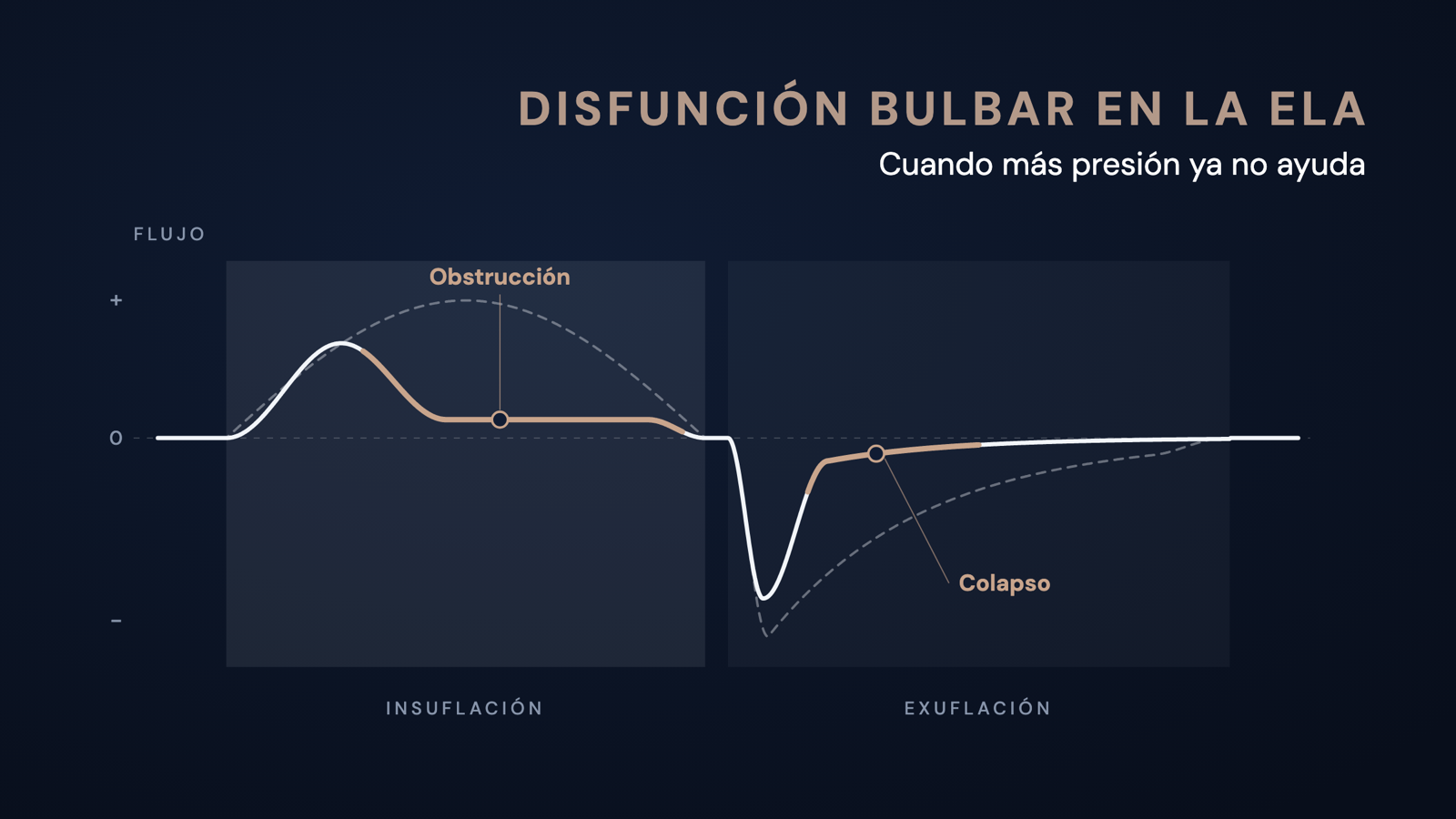 Curva de flujo esquemática de una insuflación-exsuflación mecánica: en la disfunción bulbar el flujo se aplana pronto durante la insuflación y se desploma tras el pico durante la exsuflación, en comparación con la curva normal discontinua.