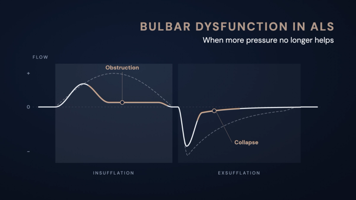 Schematic flow curve of mechanical insufflation-exsufflation: with bulbar dysfunction the flow flattens early during insufflation and collapses after the peak during exsufflation, compared with the dashed normal course.
